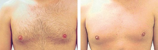 Laser Hair Removal before and after front photo