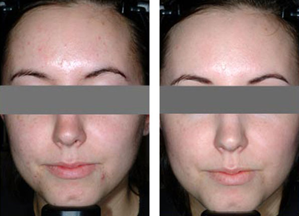 acne treatment before and after patient photo 2