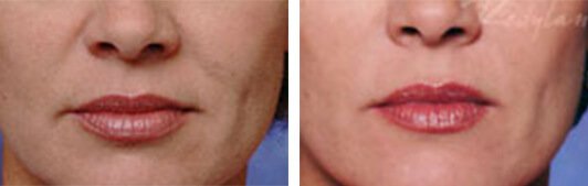 Restylane patient before and after Photo 1