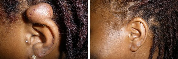 Keloids before and after side photo 4