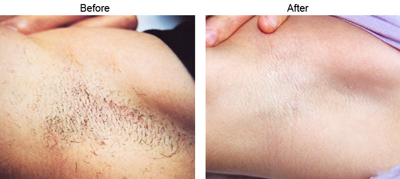 Hair Reduction Through Laser Hair Removal In Los Angeles, California