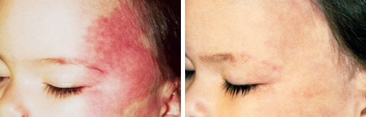V-beam Laser Treatment FAQ before and after side photo 4