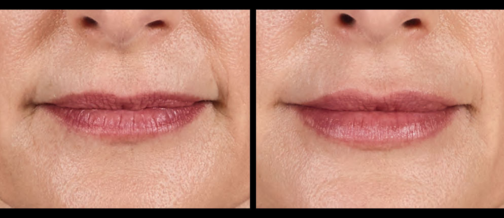 Get Luscious Lips with Juvéderm Volbella<sup style="vertical-align: top; font-size: 25px;">®</sup> XC