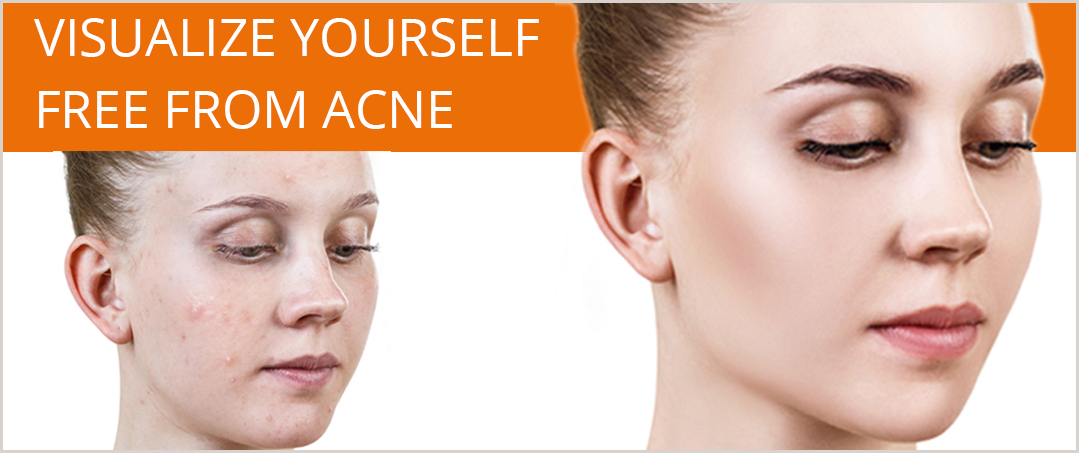 Acne Treatment in Los Angeles