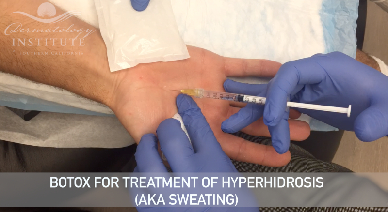Watch a demonstration of a Botox for Hyperhidrosis Treatment