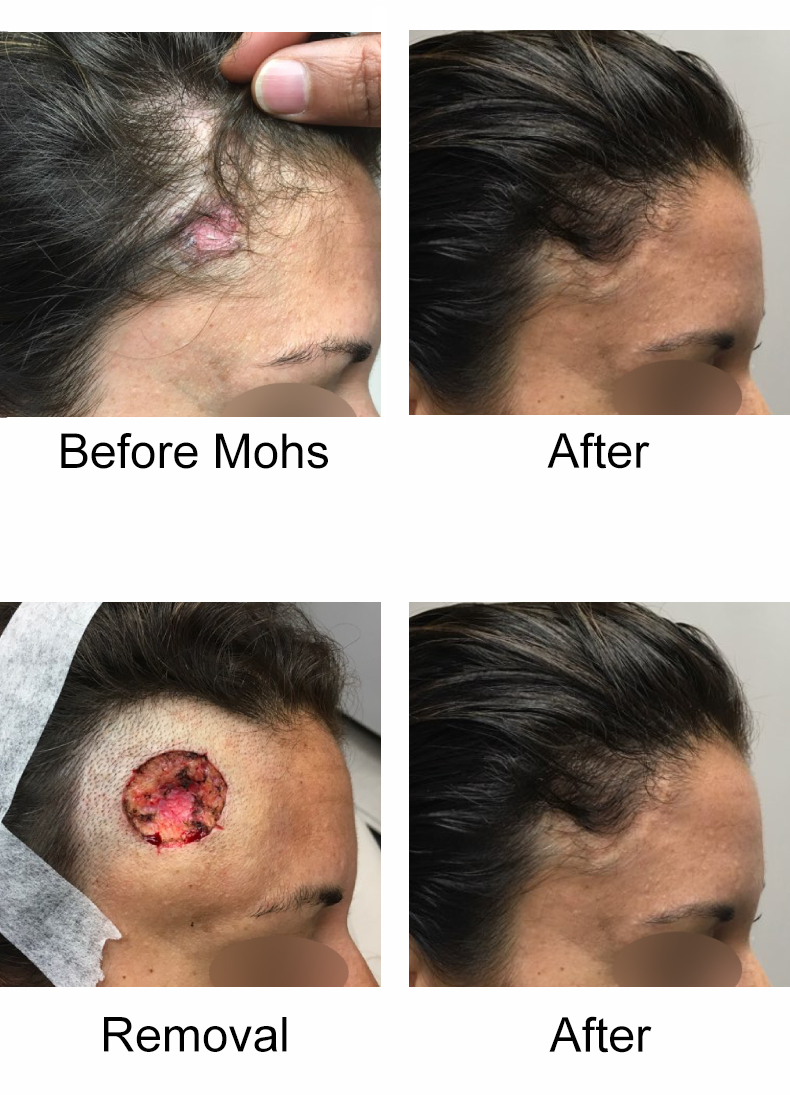 Mohs Micrographic Surgery Los Angeles L Skin Cancer Surgery Santa Monica