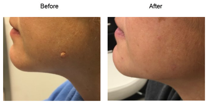 Mole Removal before and after side photo