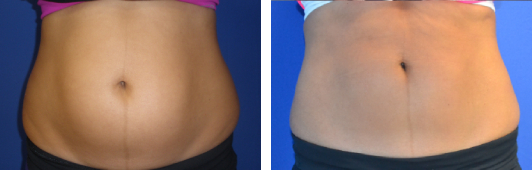 CoolSculpting Before & After Photos Beverly Hills and Santa Monica