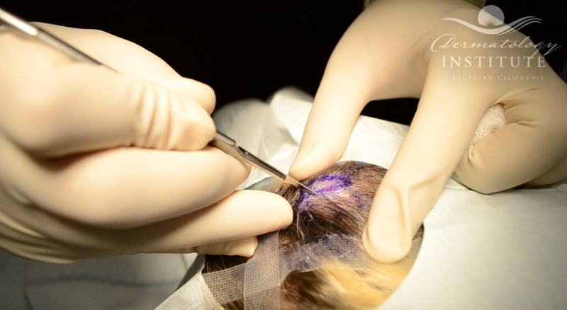 Watch Dr. Behroozan perform a demonstration of cyst removals on the scalp