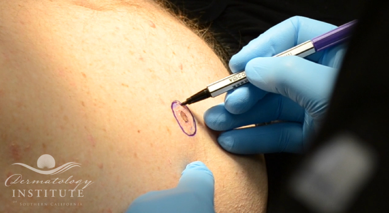 Watch Dr. Behroozan perform a Melanoma Excision (Skin Cancer)