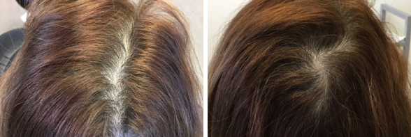 Platelet-rich Plasma Treatment for Hair Loss in Los Angeles, California