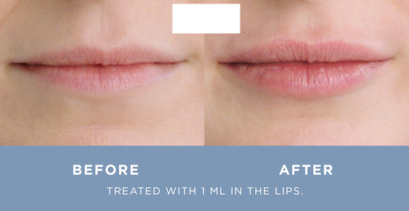 Restylane Kysse to Enhance Your Lips