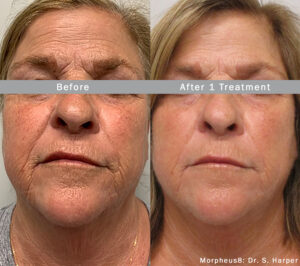 Morpheus8 Microneedling Treatment in Beverly Hills, CA & Los Angeles.