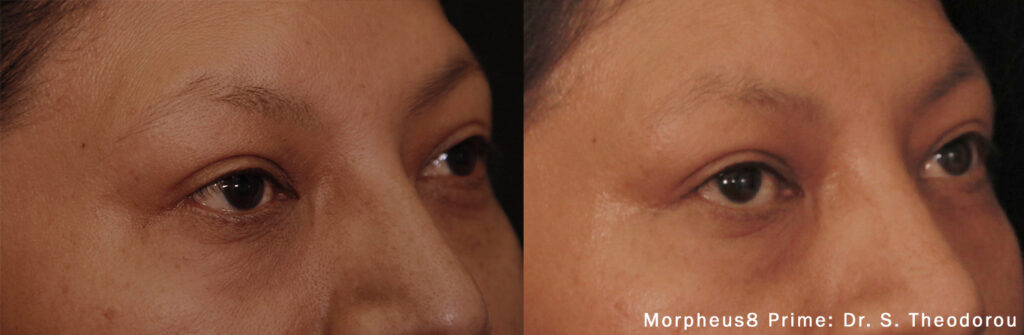 Rejuvenate Aging and Damaged Skin with Morpheus 8