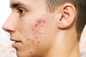 young man with acne