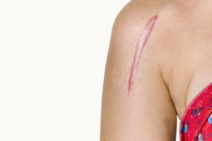 scar on woman's shoulder