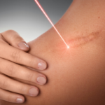 scar removal laser