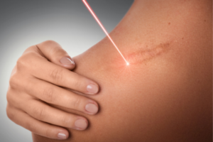 scar removal laser (types of scars)