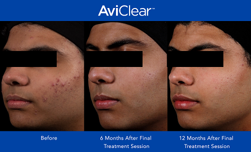 AviClear Before & After